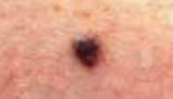 Evolve - any changes in size, shape, colour, elevation or any new symptoms such as bleeding itching or crusting may be due to a melanoma